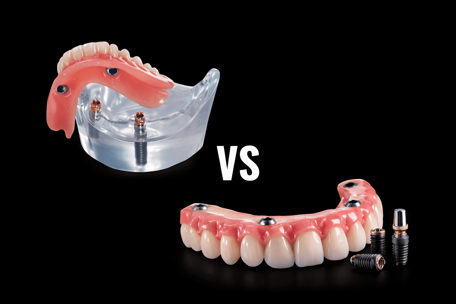 Prótesis Dentales Fijas vs. Removibles sobre Implantes para la Vida Diaria